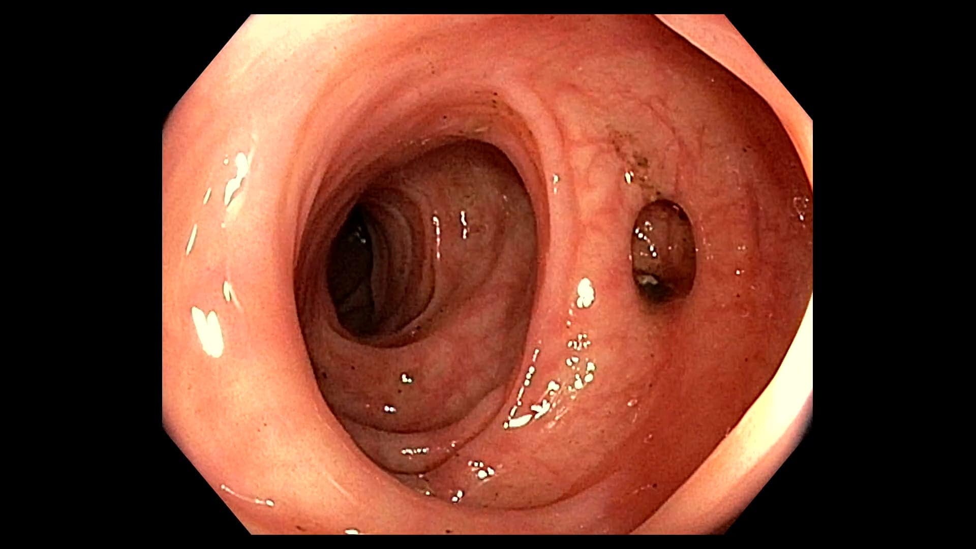 Divertículos de colon: causas y complicaciones