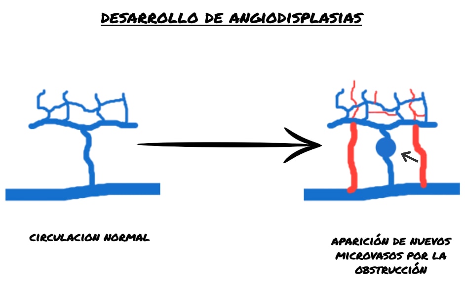 Desarrollo angiodisplasias